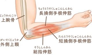 重たいものをを持つときに 肘の外側が痛む これってテニス肘 アシスト鍼灸整骨院 磐田市 アーチフィジカルケアグループ